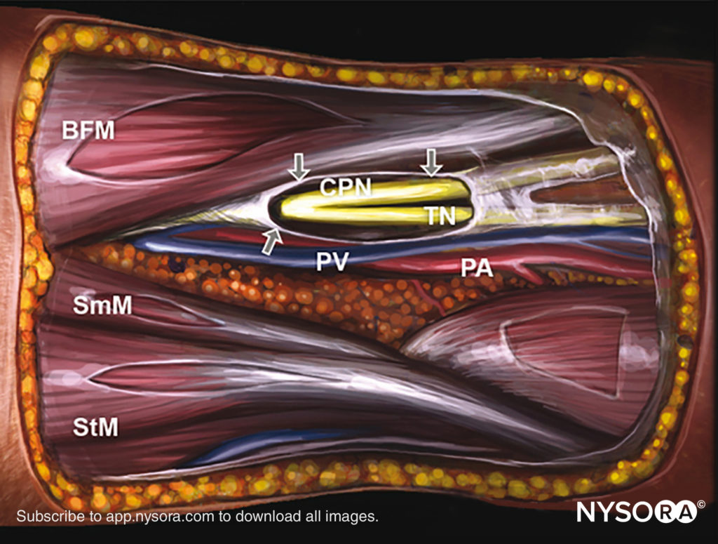 Popliteal Sciatic Nerve Block Nysora Learning Managem 4982