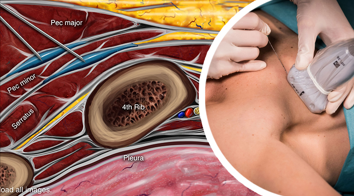 Pectoralis and Serratus Anterior Plane Block - NYSORA e-Learning System