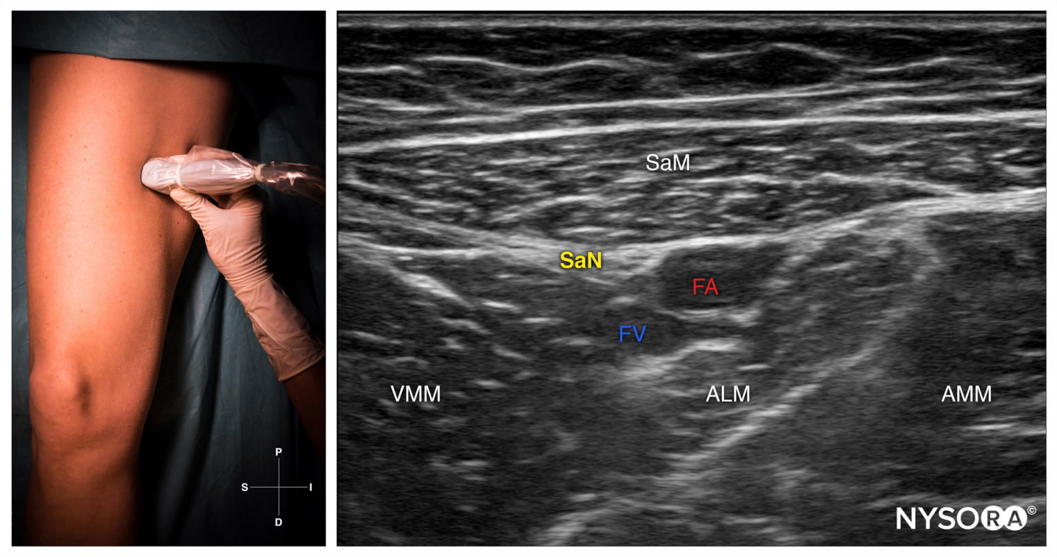 Cme Course Lower Extremity Blocks Part I Nysora E Learning System 3545